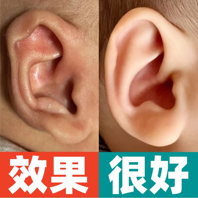 耳朵矫正器婴儿新生的儿硅胶耳撑垂耳招风耳耳夹耳廓纠正定型神器