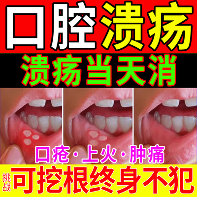 【自营】口腔溃疡特效药专用药舌头一点灵凝胶贴喷剂散专用漱口水