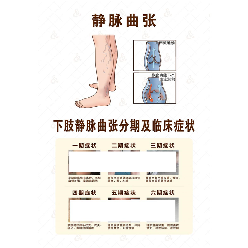 静脉曲张康复操海报体质腿部保养养生海报贴纸挂画kt板