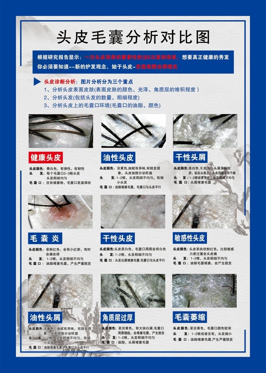 头皮毛囊分析对比图海报展板头皮理疗常见头皮归类毛囊细胞再生术