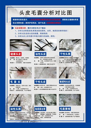 头皮毛囊分析对比图海报展板头皮理疗常见头皮归类毛囊细胞再生术