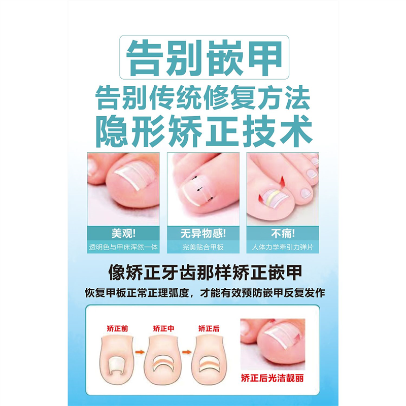 嵌甲贴片广告贴纸海报会灰指甲店背景墙甲沟炎手脚常见病图谱矫正