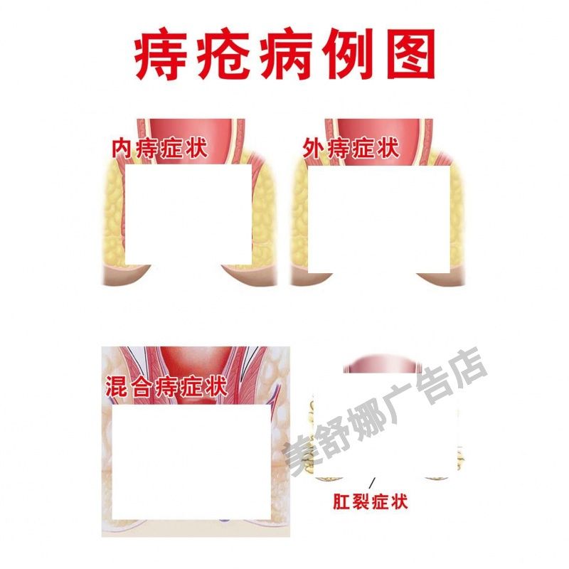 痔疮肛肠科肛门直肠解剖图自粘海报人体器官解剖图医院疾病挂图画