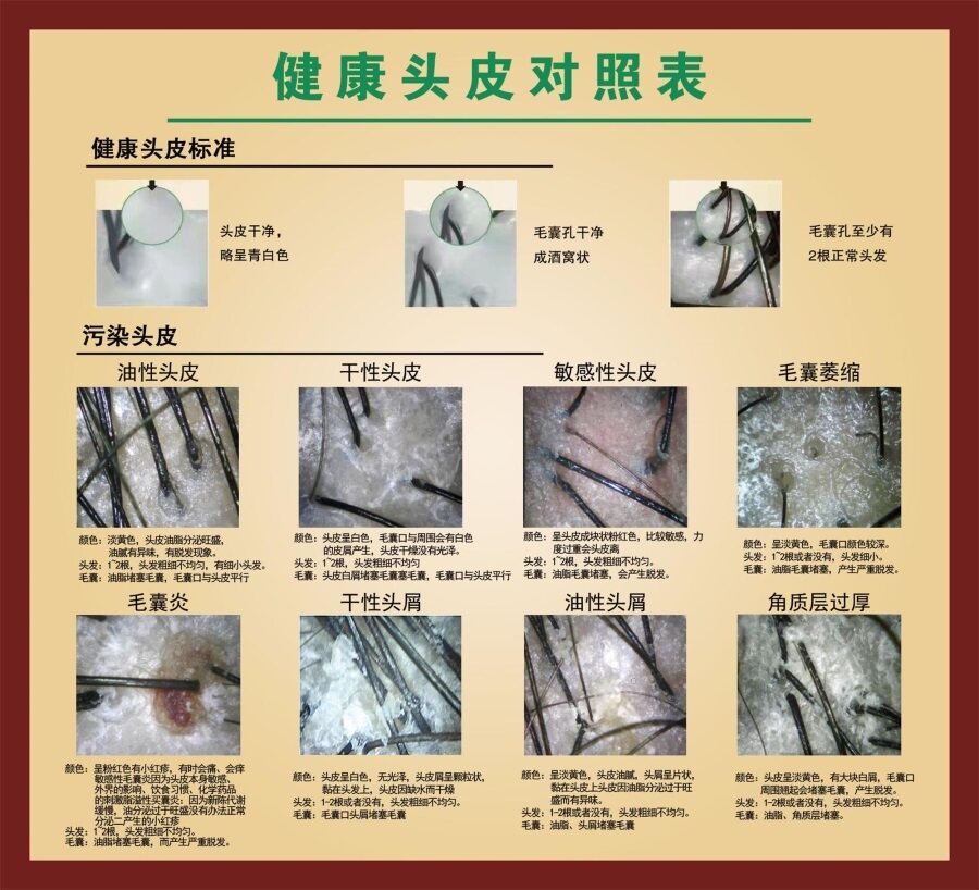 健康头皮对照表海报展板把根留住洗发露挂图无痕毛囊移植术墙贴