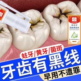 牙齿缝牙黑斑去除有黑线渍儿童成人去牙菌斑祛除神器牙黄变白喷剂