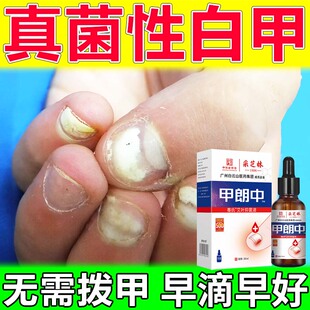 真菌性白甲手脚趾指甲盖变厚发黄甲肉分离空甲灰指甲甲朗中抑菌液