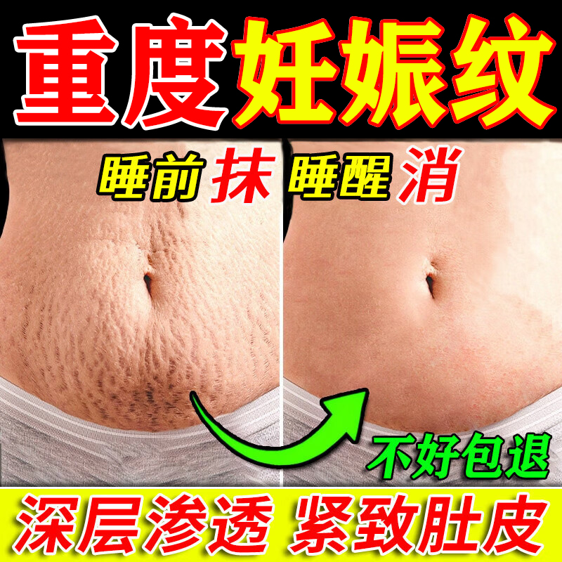 妊娠纹修复NO.1【100%修复】