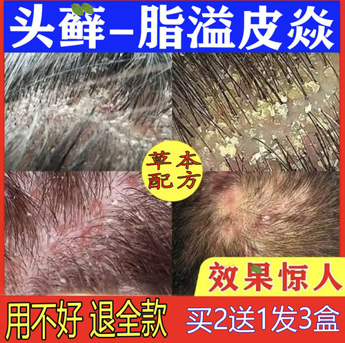 治头皮屑藓脂溢性皮炎头痒毛囊炎病真菌感染专用屑