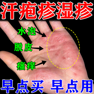 汗疱疹药膏喷雾治手上起小水泡瘙干裂痒脱皮反复真菌感染手癣正品