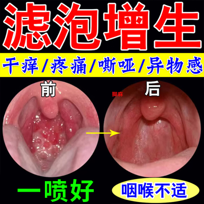 随喷随妤】喉咙滤泡增生咽喉B焱淋巴滤泡舌根滤泡干痒咳嗽有异物