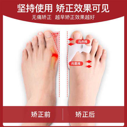脚趾矫正器分趾器大母脚趾头足纠正指姆可穿鞋软胶拇指外翻男女士