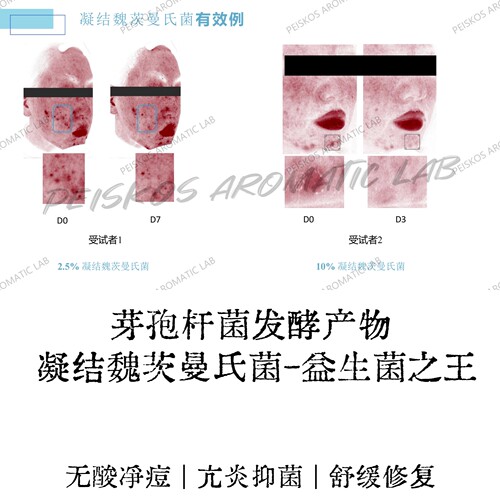 胞外蛋白净痘剂凝结魏茨曼氏菌芽孢杆菌发酵产物无酸清痘控油原料