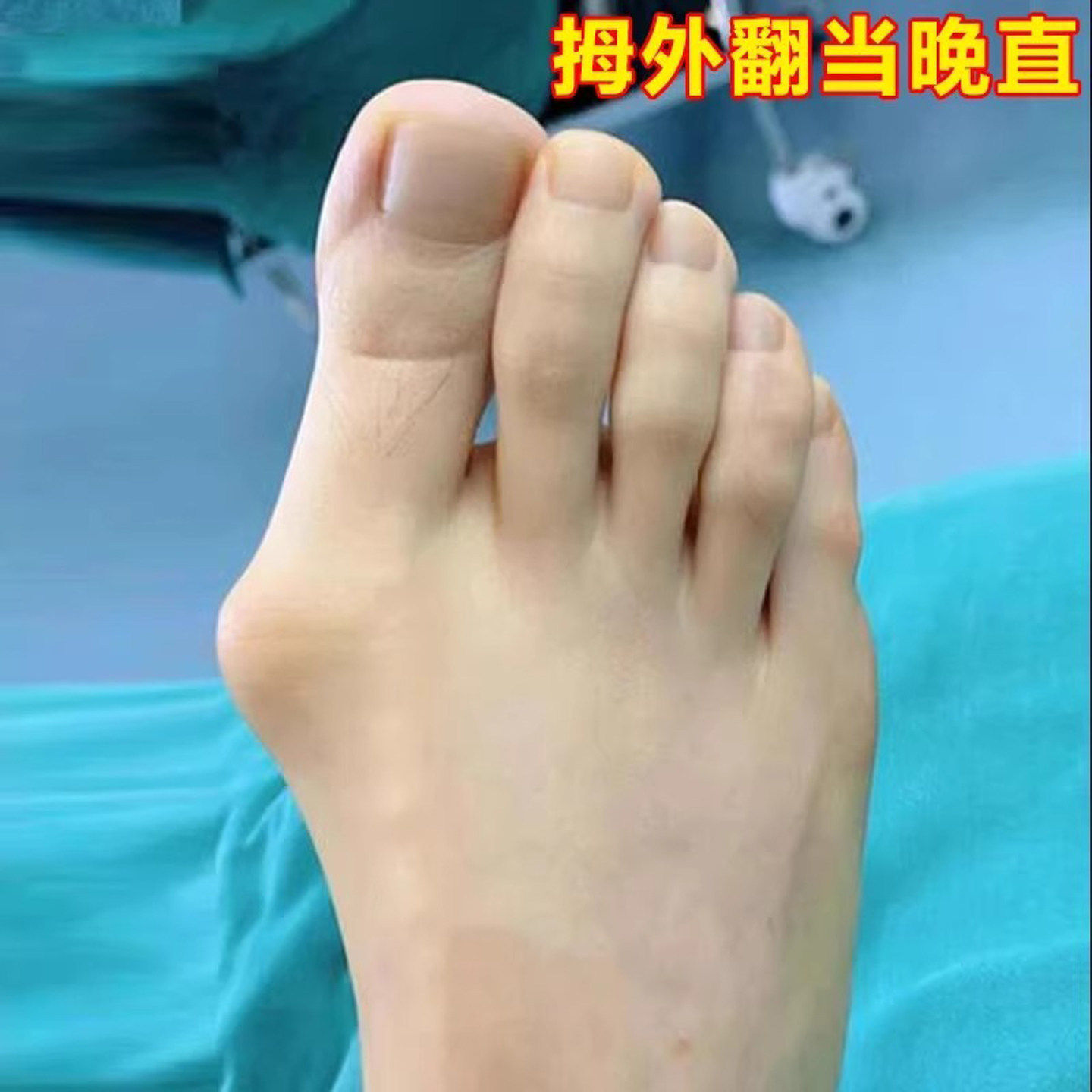 【已冶愈10万人】拇外翻贴脚趾重叠防磨大脚骨外翻矫正专用膏药