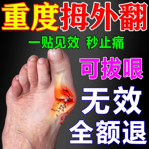 [Имеет более 100 000 человек] Специальная штукатурка для перекрывающихся пальцев ног перекрывающихся пальцев ног