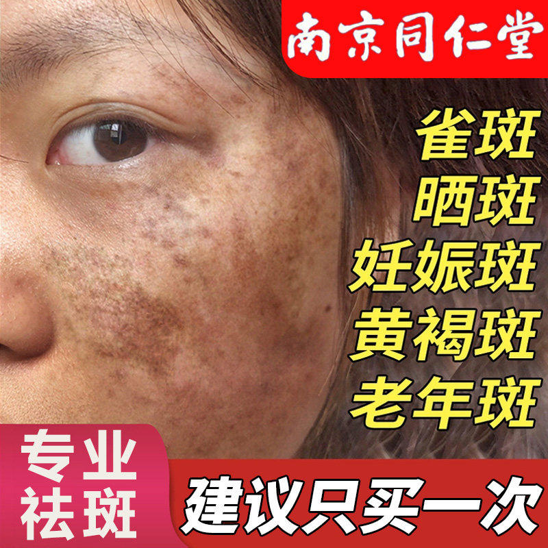 美白祛斑霜纯中药去斑正品官方旗舰店草本祛黄早晚淡化色斑第-名