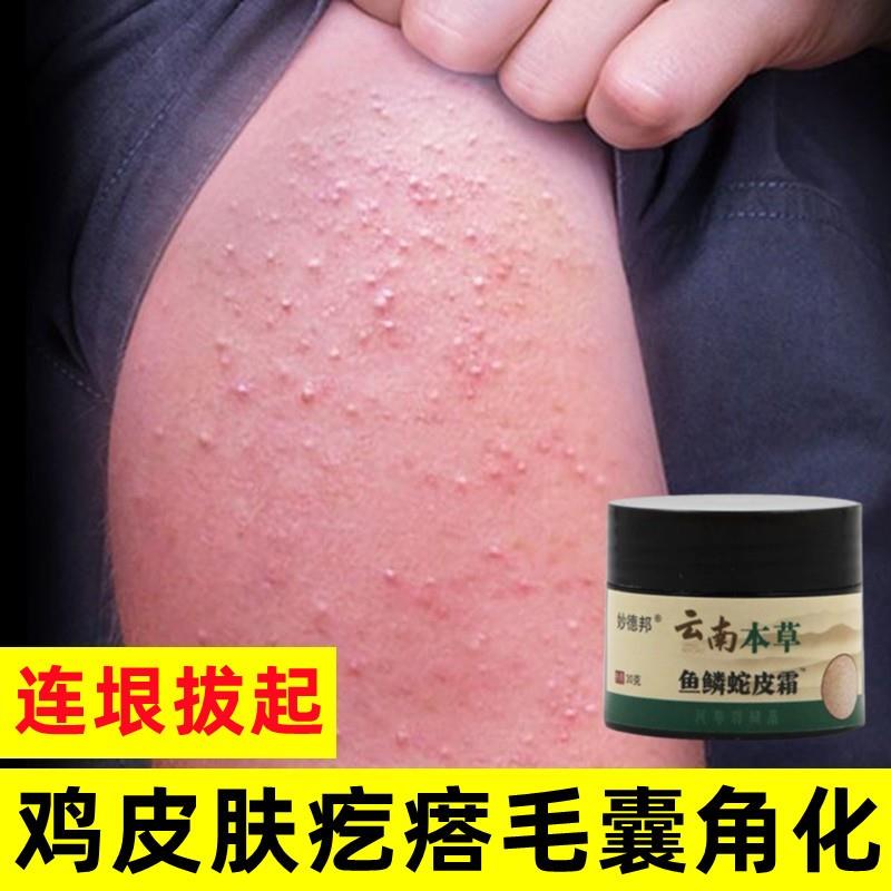 鸡皮肤疙瘩毛囊角化药膏去除神器毛周角化症身体乳鱼鳞病皮肤霜