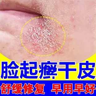 脸起皮干燥有碎屑修复霜嘴角皮肤干燥红痒换季脸下巴起皮过敏红痒