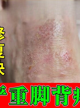 脚背干痒脚面上长小红点起红疙瘩红斑点皮肤干燥脱屑越挠越痒膏药
