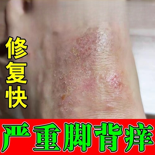 脚背很痒脚面上长小红点起红疙瘩红斑点皮肤干燥脱屑越挠越痒药膏