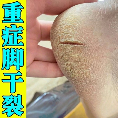 脚后跟干裂修复霜足跟粗糙开裂口瘙痒脚底起硬皮脱皮角质增厚药膏