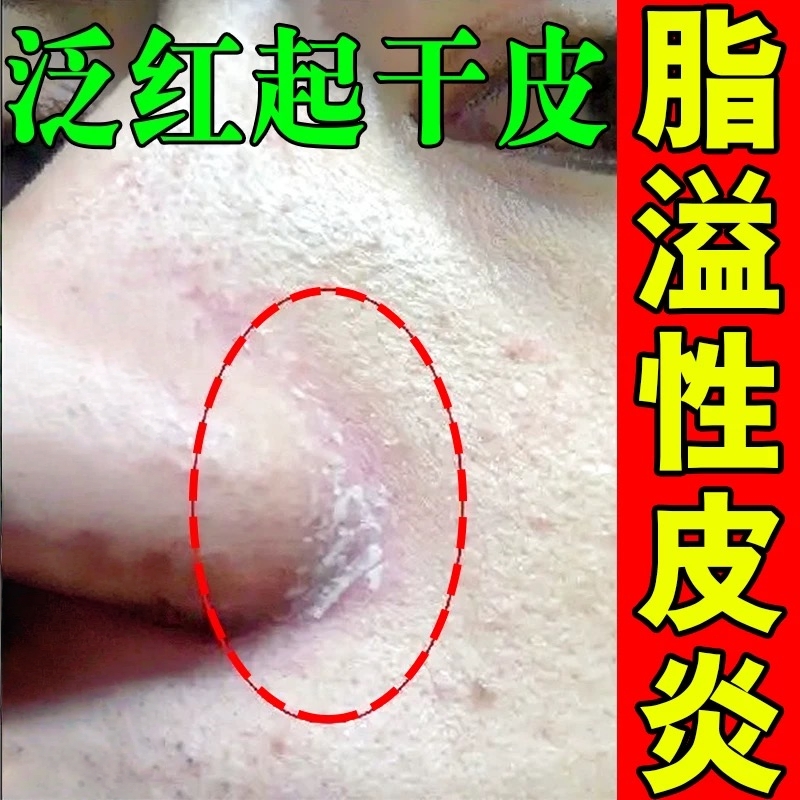 鼻子两侧发红脱皮脂溢性皮炎干燥脱皮发红发痒鼻翼红肿止痒抑菌药