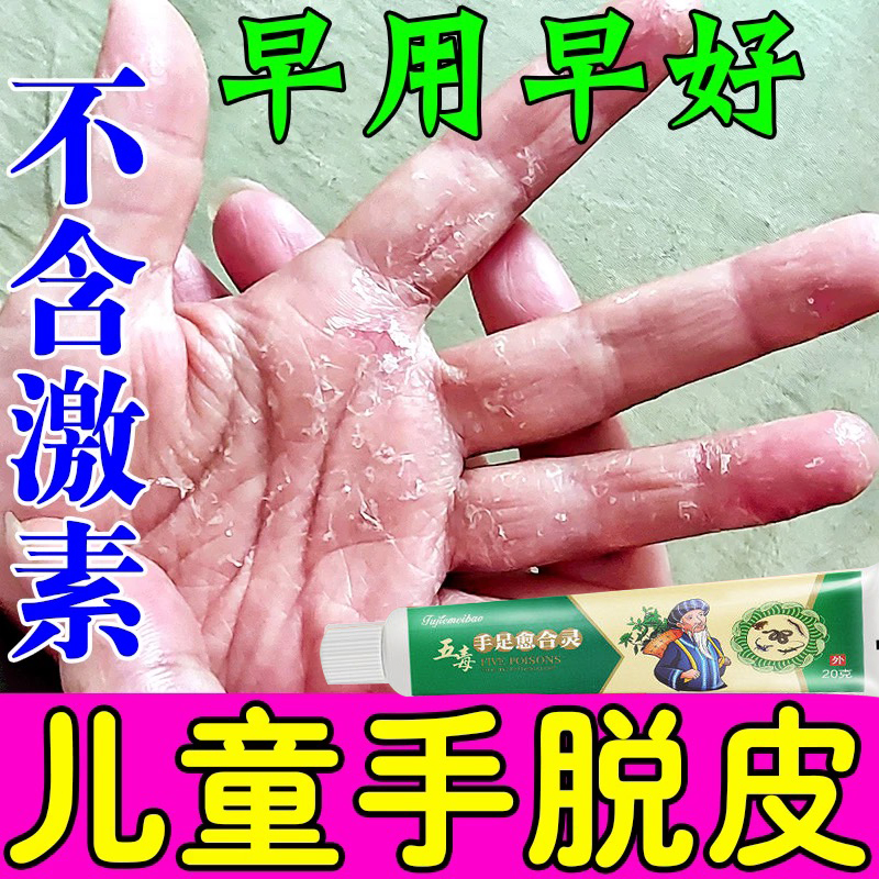 治疗手脱皮的药膏真菌感染儿童手脱皮干裂严重蜕皮干燥起皮护手霜