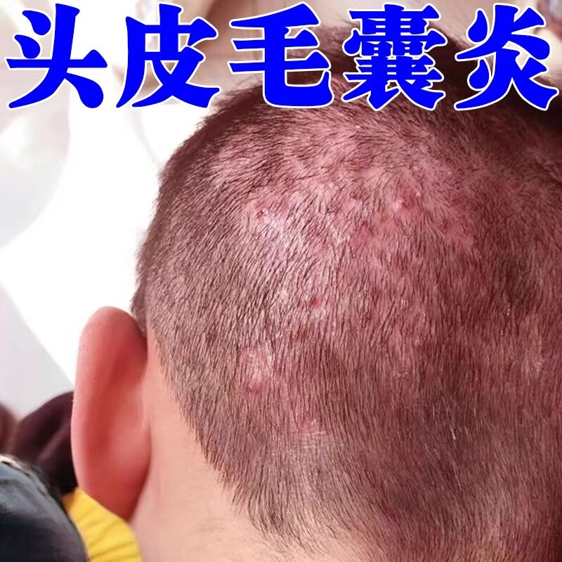 头皮毛囊炎头上长痘痘硬块疙瘩药头部红肿起脓包毛囊发炎痒外用膏