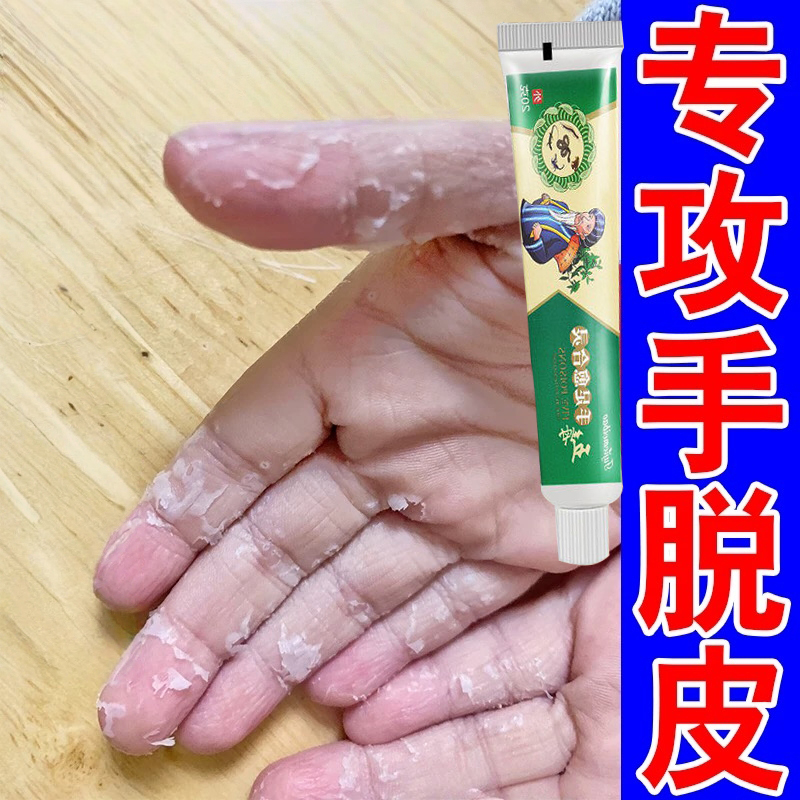 手脱皮专用药膏手脚干裂起皮痒治疗小孩手指头严重干燥蜕皮修复霜