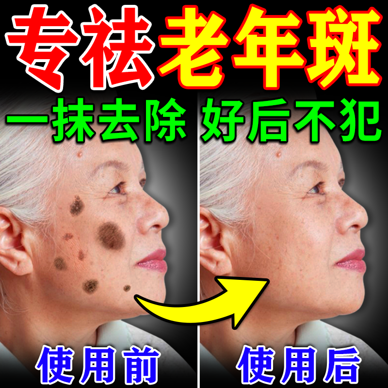 【800%包去除】老年斑专用药膏