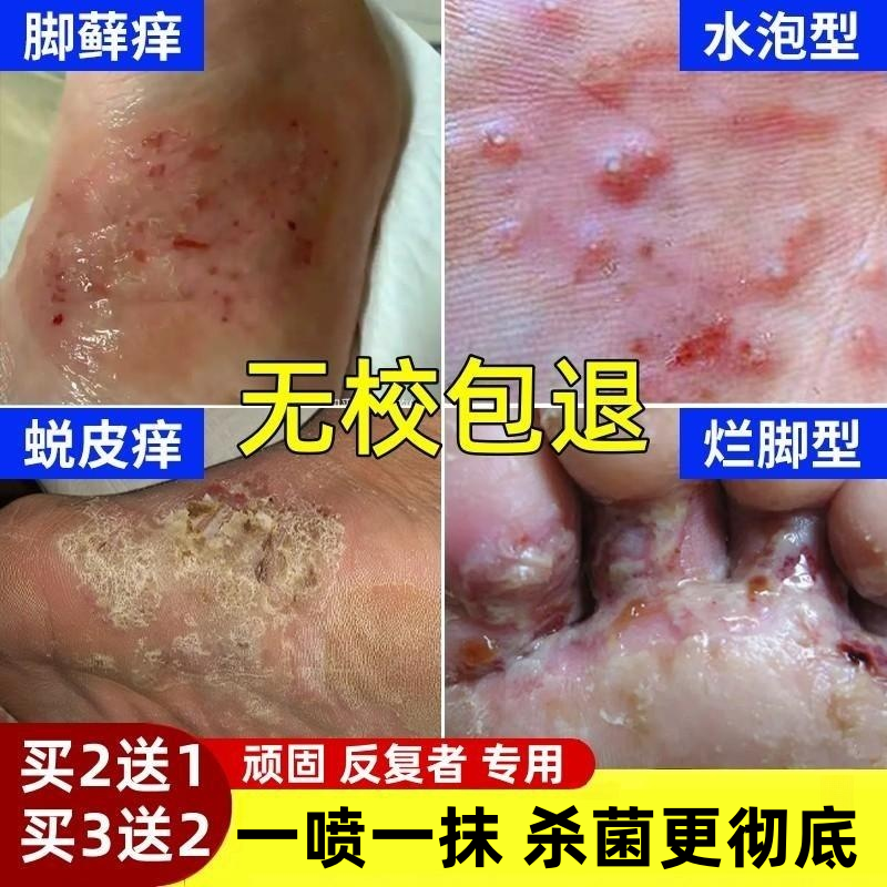 严重脚气克星3天无校全额退