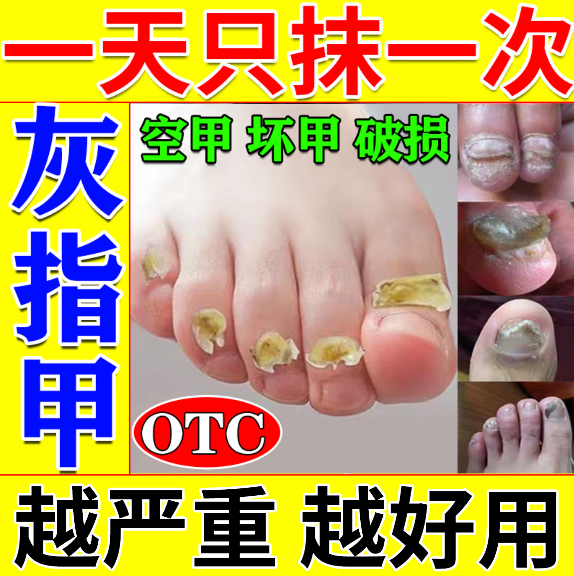 灰指甲治疗专用药膏抗真菌药水正品旗舰店亮甲癣抑菌液非特效6BF