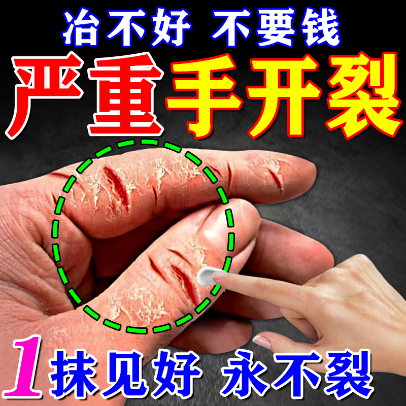 治手裂的药膏手指干燥粗糙爆干皮