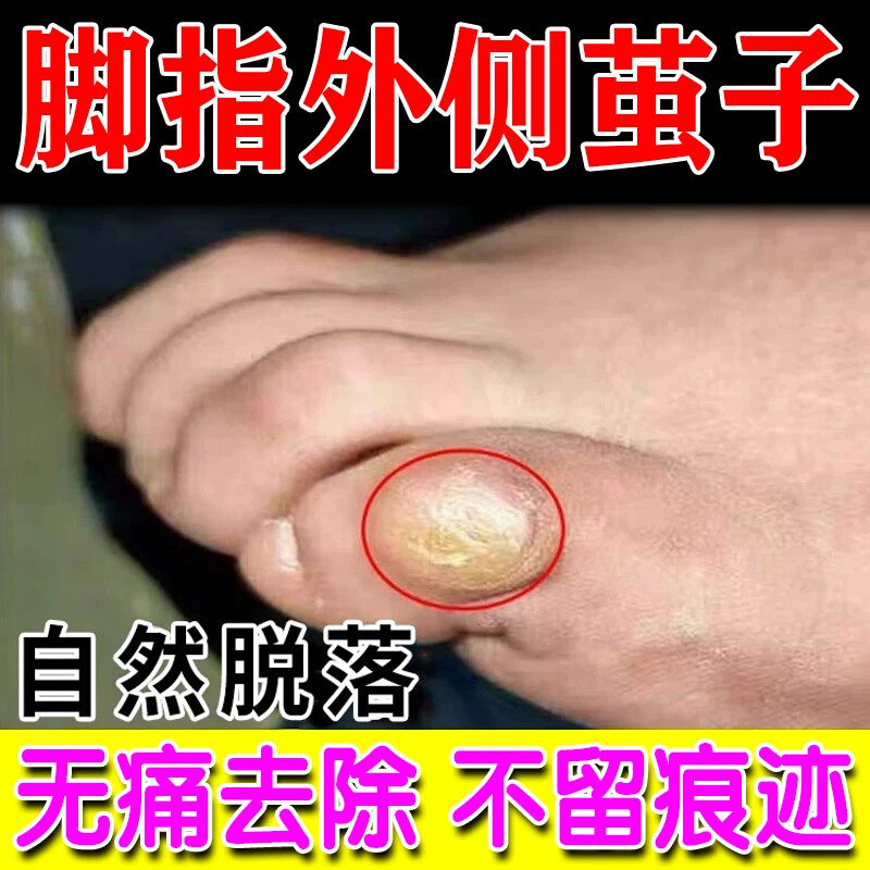 清茧灵去脚指头外侧手指上茧子老茧厚茧死皮脱落去除厚脚垫脚钉膏