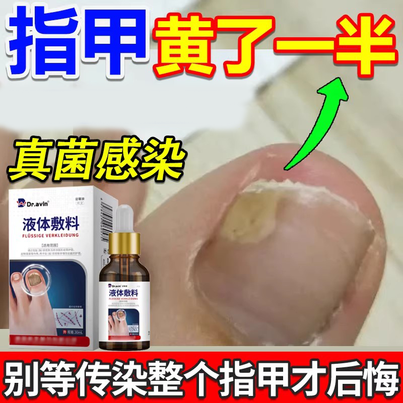 脚指甲发黄增厚变空形疗分层灰指甲盖脱甲膏专用神器真菌感染xj