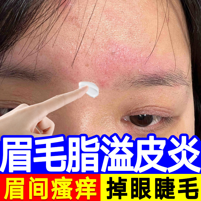 脸上眉毛处眼皮痒脂溢性皮炎湿疹红肿起皮掉睫毛面部真菌感染hy