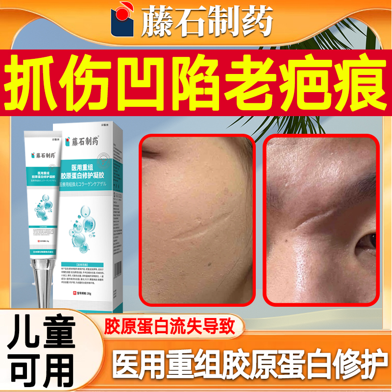 去疤膏抓伤生长因子修凹陷性面部划伤疤痕填充长肉复除疤祛疤膏xj