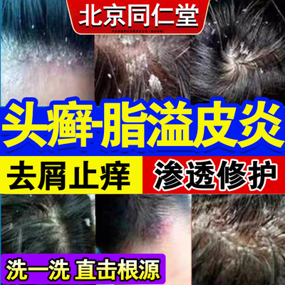 【北京同仁堂】脂溢性皮炎洗发剂