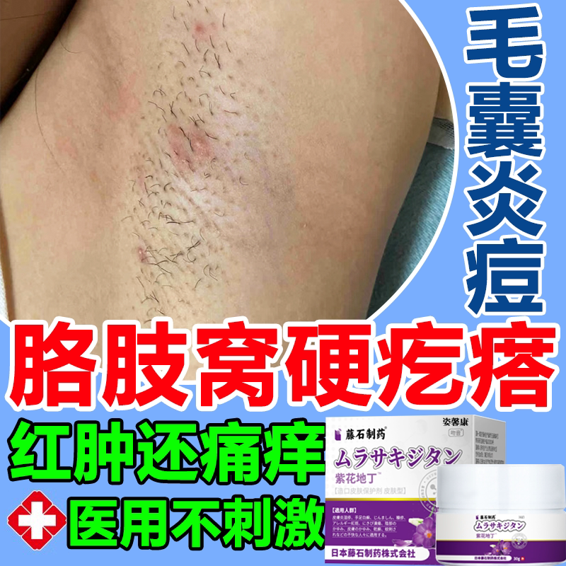 腋下毛囊炎长痘痘脓包脂溢性咯吱腋窝抑菌火疖子硬疙瘩拔毒脓膏wg