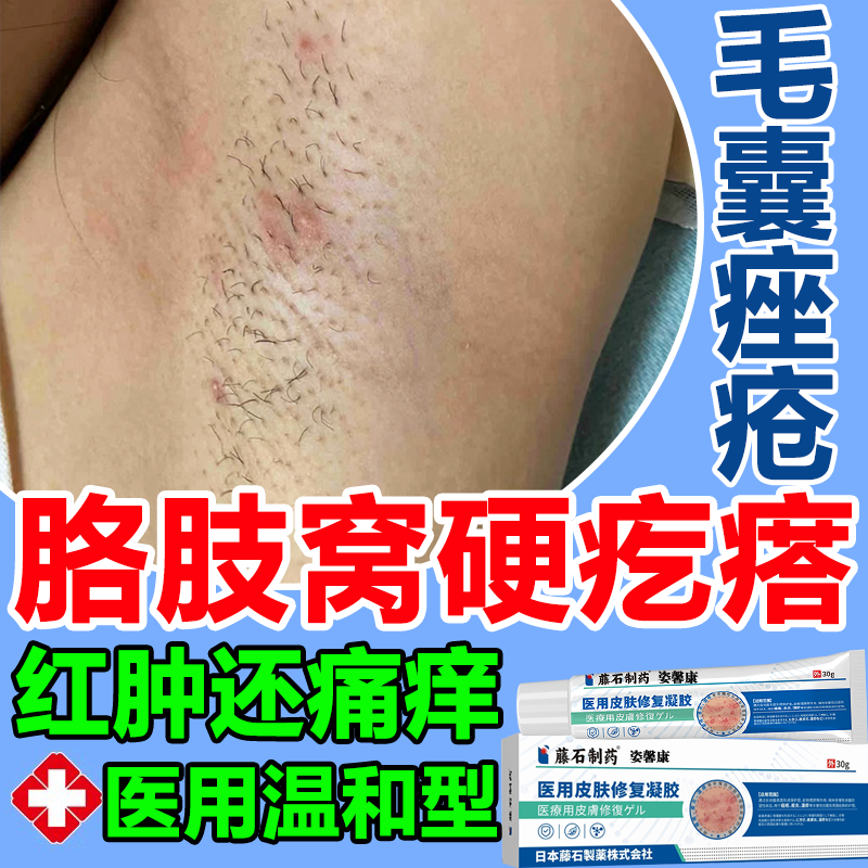 腋下毛囊炎痘痘火疖子硬疙瘩痤疮
