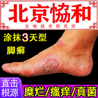 【北京协和生物医药】脚癣一次净