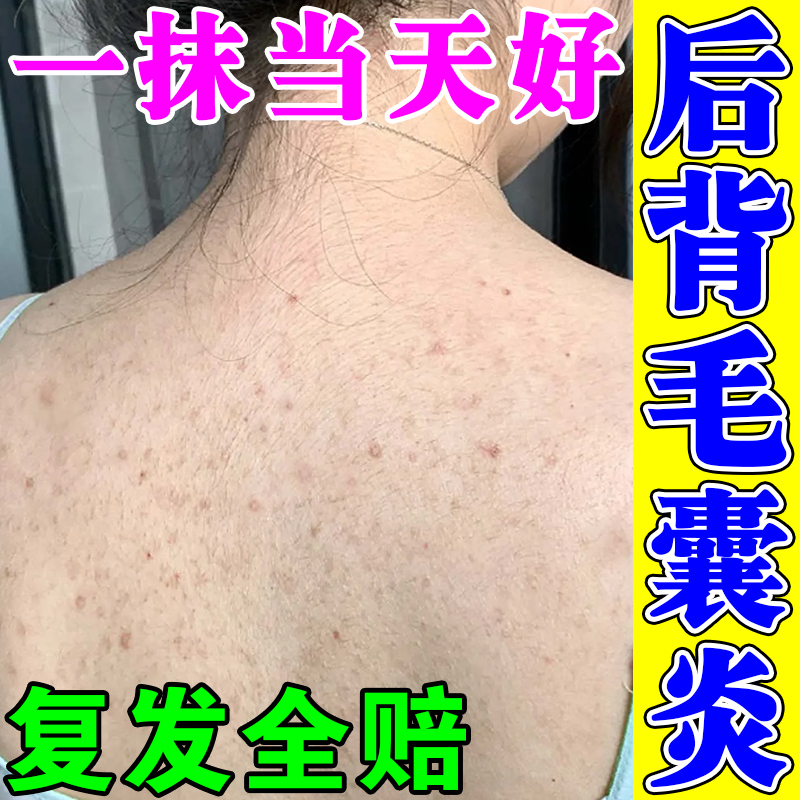 后背毛囊炎特效药去除背上长痘痘瘙痒学生前胸背部红肿祛痘印药膏