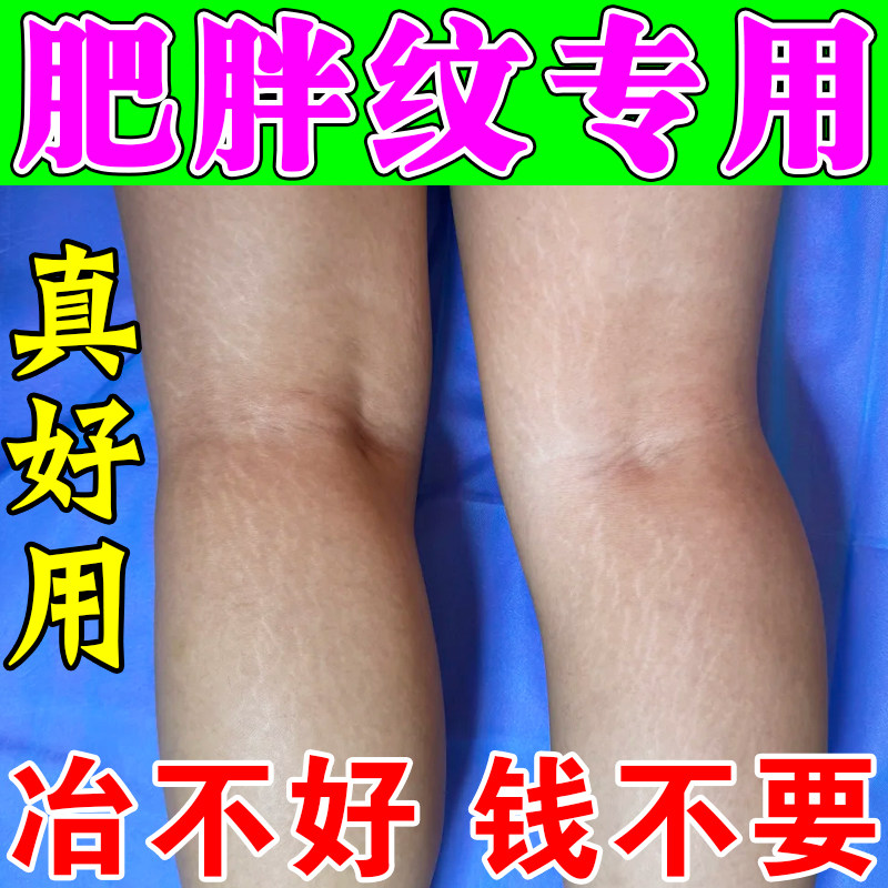 去除肥胖纹修复霜淡化生长纹消除学生大小腿部白色肥胖纹路淡纹膏