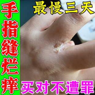 手指缝溃烂痒药膏烂手丫指缝间泛红脱皮开裂口疼痛结痂专用药软膏