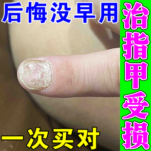 甲床修复生长液手脚指甲真菌感染凹凸不平啃咬指甲受损萎缩修复液