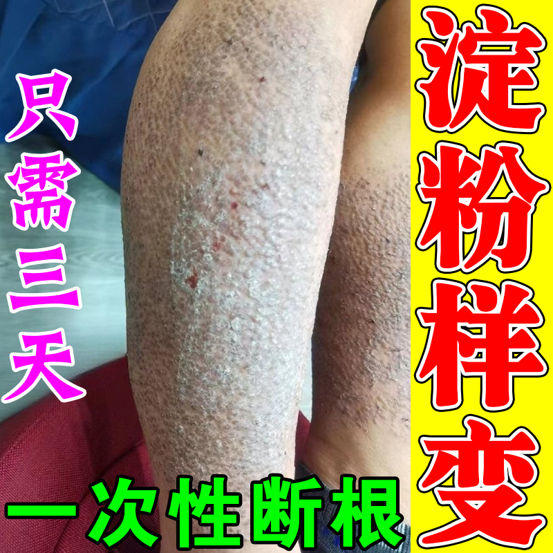 皮肤淀粉样变专用药治疗顽固小腿粗糙小颗粒疙瘩黑色素沉淀止痒膏