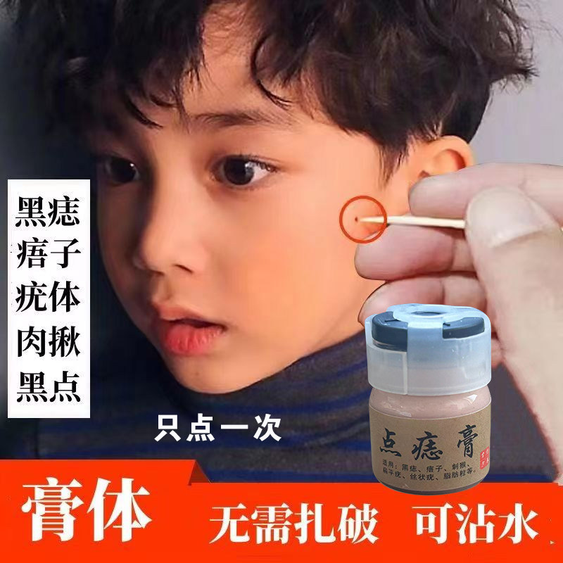 祛痣点痣无痕正品药水刺猴去除去黑痣痦子黑点瘊子祛除神器除痣膏