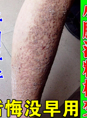 皮肤淀粉样变专用药治疗顽固黑色素沉淀小腿粗糙疙瘩皮黑斑腿痒膏