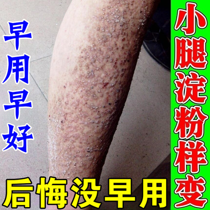 皮肤淀粉样变专用药治疗顽固黑色素沉淀小腿粗糙疙瘩皮黑斑腿痒膏