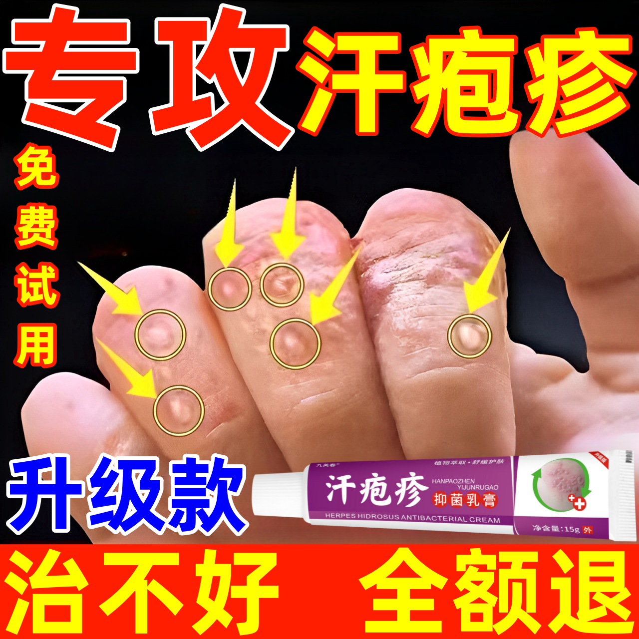 汗泡疱疹药膏手上起小水泡汗状疱疹止痒汉状真菌感染手气专用软膏