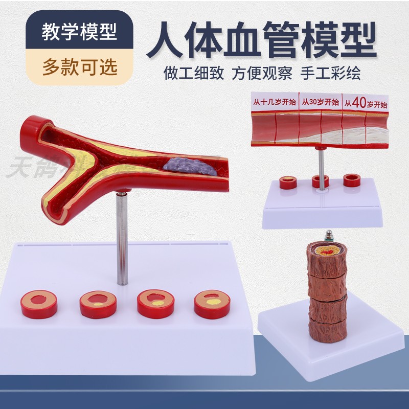 血管/堵塞动支脉粥样/硬化心血管动脉/ 硬化模型血管病理模型血栓